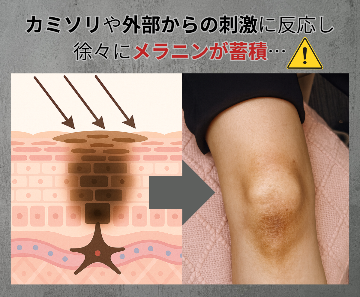 黒ずんだ角質の図